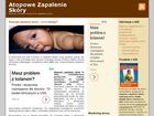 Miniatura strony atopowe-zapalenie.infoabc.pl